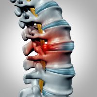 Car Accident Cause A Bulging Disc