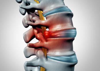 Can A Car Accident Cause A Bulging Disc? Can A Car Accident Cause A Bulging Disc?