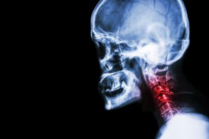 Car Accident Cause Spondylosis