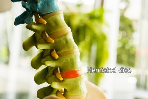 Herniated Disc